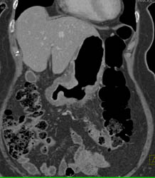 Antral Carcinoma - CTisus CT Scan