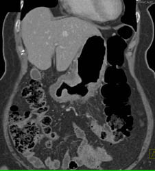 Antral Carcinoma - CTisus CT Scan