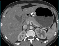 GIST Tumor - CTisus CT Scan