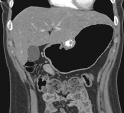 GIST Tumor - CTisus CT Scan