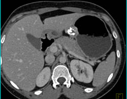 GIST Tumor - CTisus CT Scan