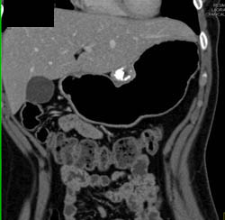 GIST Tumor - CTisus CT Scan