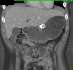 GIST Tumor - CTisus CT Scan