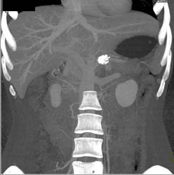 GIST Tumor - CTisus CT Scan