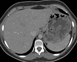 Gastric Polyps in Polyposis Syndrome - CTisus CT Scan