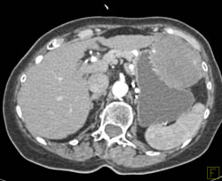 GIST Tumor - CTisus CT Scan