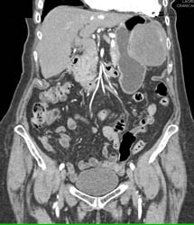 GIST Tumor - CTisus CT Scan