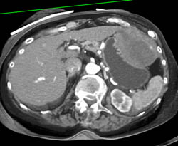 GIST Tumor - CTisus CT Scan