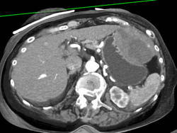 GIST Tumor - CTisus CT Scan