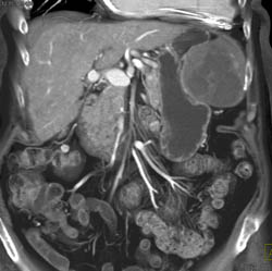 GIST Tumor - CTisus CT Scan