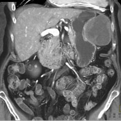 GIST Tumor - CTisus CT Scan