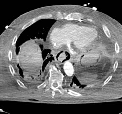 Gastric and Esophageal Emphysematous Changes With Portal Vein Air Compatible With Massive Infarction - CTisus CT Scan