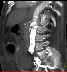 Small SMA and Celiac With Gastric Emphysema - CTisus CT Scan