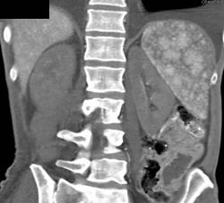 Gastric Cancer - CTisus CT Scan