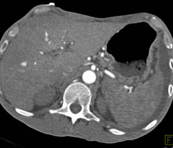 Gastric Cancer - CTisus CT Scan