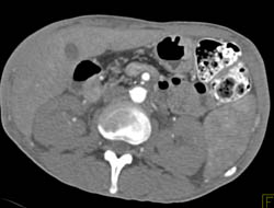 Gastric Cancer - CTisus CT Scan