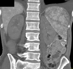 Gastric Cancer - CTisus CT Scan