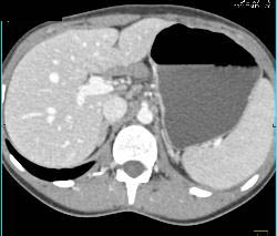 Desmoid Tumors and Fluid in Lesser Sac Pushing on the Stomach - CTisus CT Scan