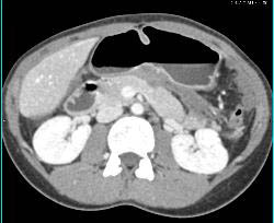 Desmoid Tumors and Fluid in Lesser Sac Pushing on the Stomach - CTisus CT Scan