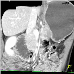 Infiltrative Carcinoma With Implants and Gastric Obstruction - CTisus CT Scan