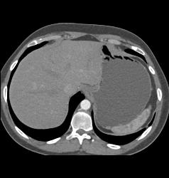 Antral Carcinoma - CTisus CT Scan