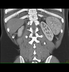 Antral Carcinoma - CTisus CT Scan