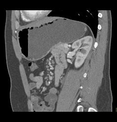 Antral Carcinoma - CTisus CT Scan