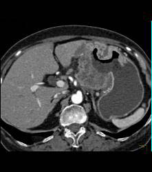 Antral Carcinoma With Adenopathy - CTisus CT Scan