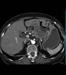 Antral Carcinoma With Adenopathy - CTisus CT Scan