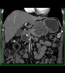 Antral Carcinoma With Adenopathy - CTisus CT Scan