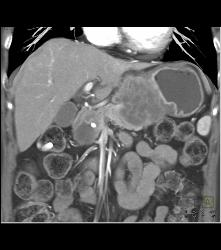 Antral Carcinoma With Adenopathy - CTisus CT Scan