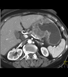 Antral Carcinoma With Adenopathy - CTisus CT Scan