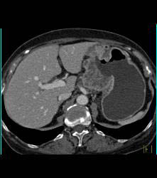 Antral Carcinoma With Adenopathy - CTisus CT Scan