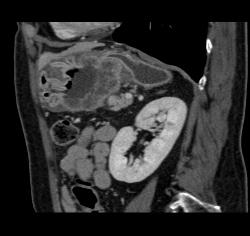 Antral Carcinoma With Adenopathy - CTisus CT Scan