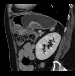 Antral Carcinoma With Adenopathy - CTisus CT Scan