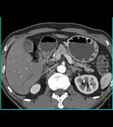 Antral Carcinoma - CTisus CT Scan