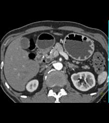 Antral Carcinoma - CTisus CT Scan