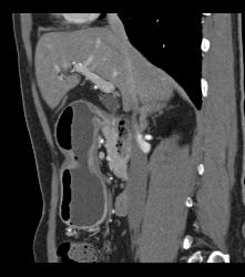 Antral Carcinoma - CTisus CT Scan