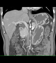 Thickened Gastric Folds - CTisus CT Scan