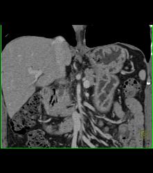 Thickened Gastric Folds - CTisus CT Scan