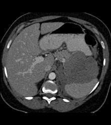 GIST Tumor - CTisus CT Scan