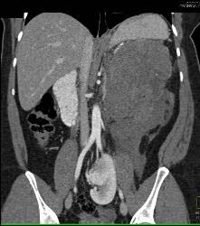 GIST Tumor - CTisus CT Scan