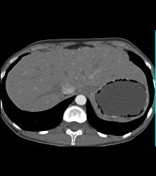 Antral Carcinoma - CTisus CT Scan