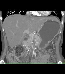 Antral Carcinoma - CTisus CT Scan