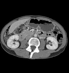 Antral Carcinoma - CTisus CT Scan