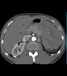 GIST Tumor With Ulceration - CTisus CT Scan