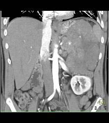 GIST Tumor With Ulceration - CTisus CT Scan