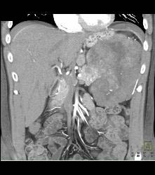 GIST Tumor With Ulceration - CTisus CT Scan