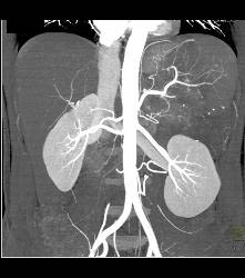 GIST Tumor With Ulceration - CTisus CT Scan