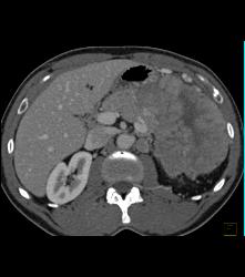 GIST Tumor With Ulceration - CTisus CT Scan